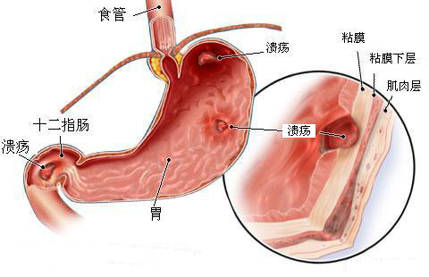 中西医结合治疗消化性溃疡，标本兼治疗效好