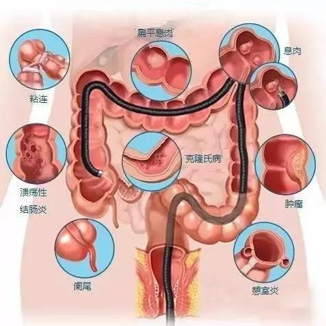 肠炎的常见检查有哪些？